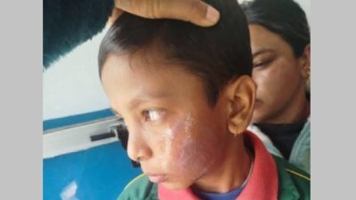 विद्यार्थीको गालामा तातो पन्युले डाम्ने शिक्षिका थप पाँच दिन हिरासतमा