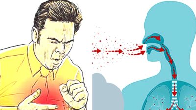 झापामा क्षयरोगका सात सय नयाँ बिरामी
